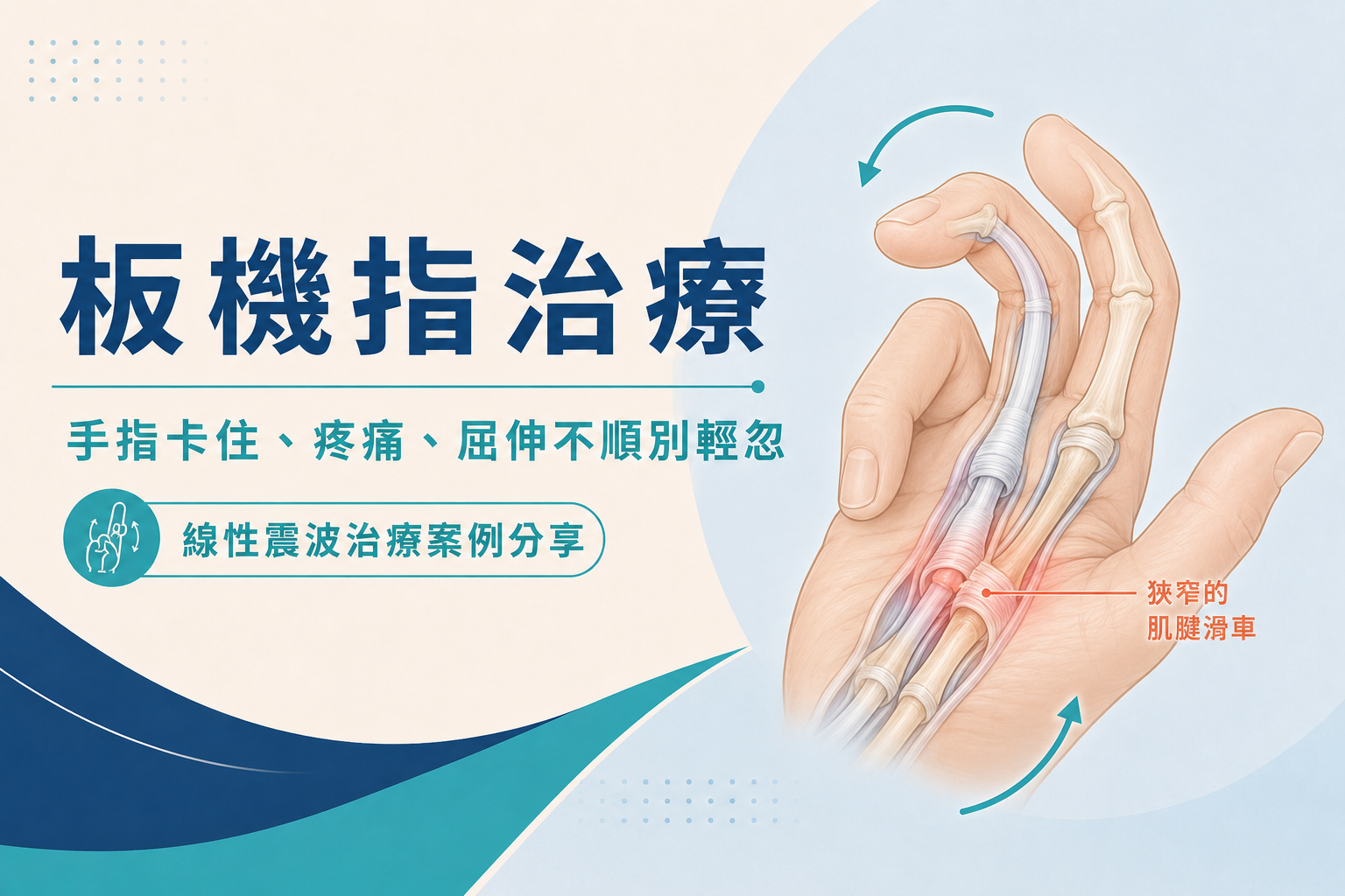 板機指治療